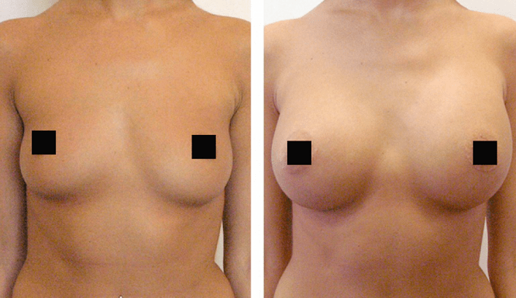 krūtis pirms un pēc palielināšanas ar hialuronskābi