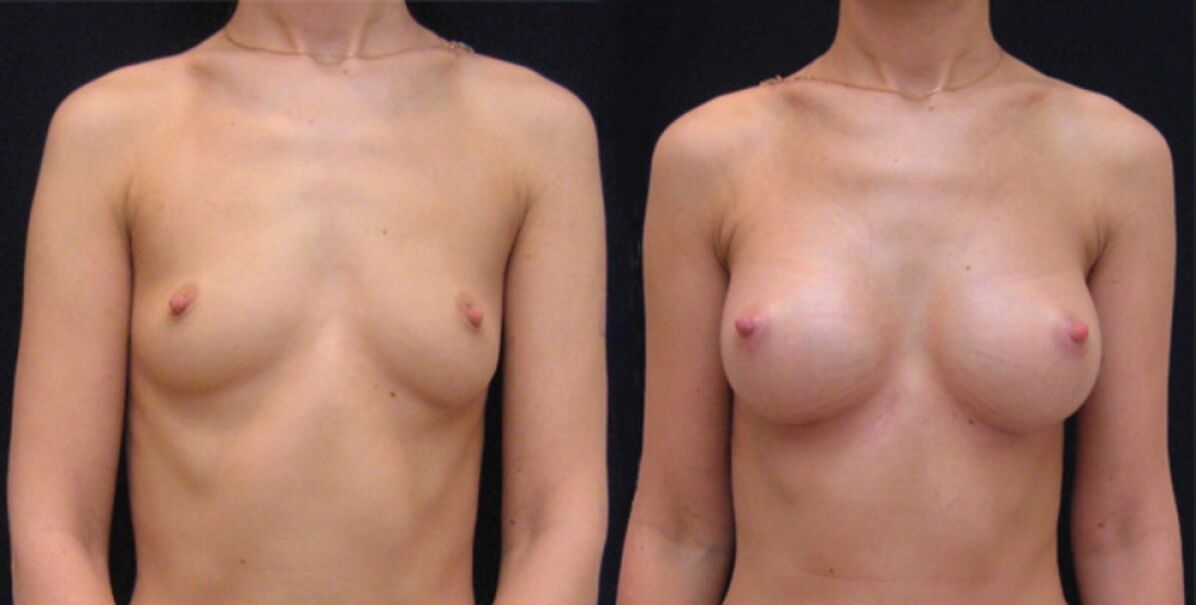 krūtis pirms un pēc endoskopiskās palielināšanas